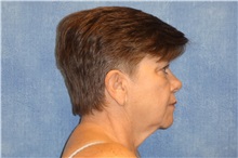 Facelift Before Photo by George John Alexander, MD, FACS; ,  - Case 31306
