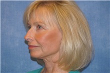 Facelift After Photo by George John Alexander, MD, FACS; ,  - Case 31309