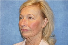 Facelift Before Photo by George John Alexander, MD, FACS; ,  - Case 31309