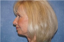Facelift After Photo by George John Alexander, MD, FACS; ,  - Case 31309