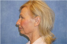 Facelift Before Photo by George John Alexander, MD, FACS; ,  - Case 31309