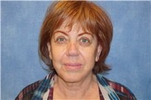 Facelift After Photo by George John Alexander, MD, FACS; ,  - Case 31310