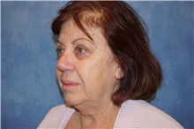 Facelift Before Photo by George John Alexander, MD, FACS; ,  - Case 31310