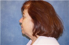 Facelift Before Photo by George John Alexander, MD, FACS; ,  - Case 31310