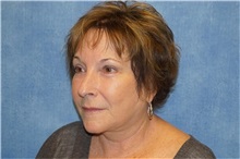 Facelift After Photo by George John Alexander, MD, FACS; ,  - Case 31311
