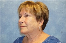 Facelift Before Photo by George John Alexander, MD, FACS; ,  - Case 31311