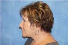 Facelift After Photo by George John Alexander, MD, FACS; ,  - Case 31311