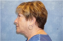 Facelift Before Photo by George John Alexander, MD, FACS; ,  - Case 31311