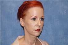 Facelift Before Photo by George John Alexander, MD, FACS; ,  - Case 31312