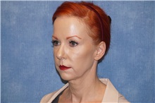 Facelift Before Photo by George John Alexander, MD, FACS; ,  - Case 31312