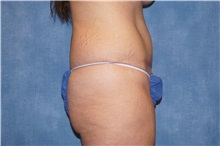 Tummy Tuck After Photo by George John Alexander, MD, FACS; ,  - Case 32111
