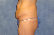 Tummy Tuck Before Photo by George John Alexander, MD, FACS; ,  - Case 32111