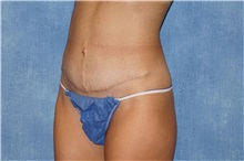 Tummy Tuck After Photo by George John Alexander, MD, FACS; ,  - Case 32112