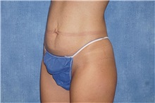 Tummy Tuck Before Photo by George John Alexander, MD, FACS; ,  - Case 32112