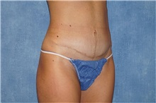 Tummy Tuck After Photo by George John Alexander, MD, FACS; ,  - Case 32112