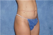 Tummy Tuck Before Photo by George John Alexander, MD, FACS; ,  - Case 32112