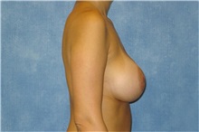 Breast Augmentation After Photo by George John Alexander, MD, FACS; ,  - Case 32121
