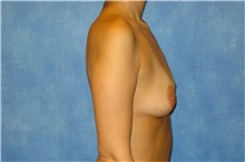 Breast Augmentation Before Photo by George John Alexander, MD, FACS; ,  - Case 32121
