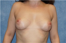 Breast Lift After Photo by George John Alexander, MD, FACS; ,  - Case 32125