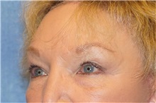 Brow Lift After Photo by George John Alexander, MD, FACS; ,  - Case 32129