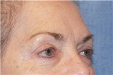 Brow Lift Before Photo by George John Alexander, MD, FACS; ,  - Case 32132