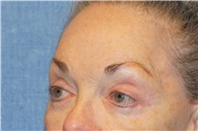 Brow Lift After Photo by George John Alexander, MD, FACS; ,  - Case 32132