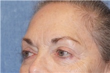 Brow Lift Before Photo by George John Alexander, MD, FACS; ,  - Case 32132