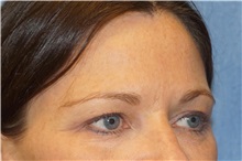 Brow Lift After Photo by George John Alexander, MD, FACS; ,  - Case 32134
