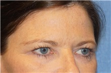 Brow Lift Before Photo by George John Alexander, MD, FACS; ,  - Case 32134