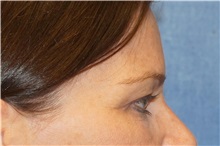 Brow Lift After Photo by George John Alexander, MD, FACS; ,  - Case 32134