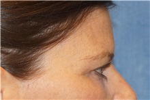 Brow Lift Before Photo by George John Alexander, MD, FACS; ,  - Case 32134