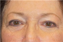 Eyelid Surgery After Photo by George John Alexander, MD, FACS; Las Vegas, NV - Case 32135