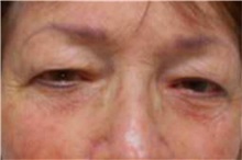 Eyelid Surgery Before Photo by George John Alexander, MD, FACS; Las Vegas, NV - Case 32135