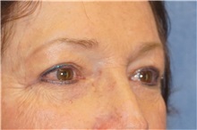 Eyelid Surgery After Photo by George John Alexander, MD, FACS; ,  - Case 32135