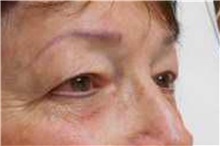 Eyelid Surgery Before Photo by George John Alexander, MD, FACS; ,  - Case 32135