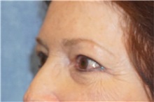 Eyelid Surgery After Photo by George John Alexander, MD, FACS; ,  - Case 32135