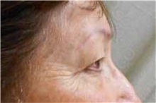 Eyelid Surgery Before Photo by George John Alexander, MD, FACS; ,  - Case 32135