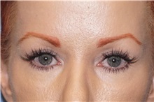 Eyelid Surgery Before Photo by George John Alexander, MD, FACS; ,  - Case 32136
