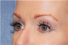 Eyelid Surgery After Photo by George John Alexander, MD, FACS; ,  - Case 32136