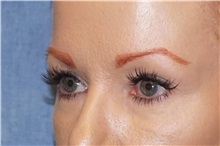 Eyelid Surgery Before Photo by George John Alexander, MD, FACS; ,  - Case 32136