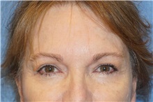 Eyelid Surgery After Photo by George John Alexander, MD, FACS; ,  - Case 32138