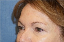 Eyelid Surgery Before Photo by George John Alexander, MD, FACS; ,  - Case 32138