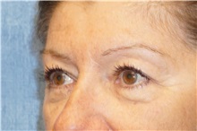Eyelid Surgery Before Photo by George John Alexander, MD, FACS; ,  - Case 32139