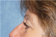Eyelid Surgery After Photo by George John Alexander, MD, FACS; ,  - Case 32139