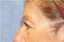 Eyelid Surgery Before Photo by George John Alexander, MD, FACS; ,  - Case 32139