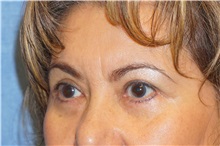 Eyelid Surgery After Photo by George John Alexander, MD, FACS; ,  - Case 32140