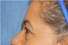 Eyelid Surgery Before Photo by George John Alexander, MD, FACS; ,  - Case 32140