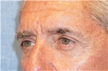 Eyelid Surgery Before Photo by George John Alexander, MD, FACS; ,  - Case 32141