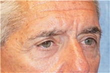 Eyelid Surgery After Photo by George John Alexander, MD, FACS; ,  - Case 32141