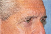 Eyelid Surgery Before Photo by George John Alexander, MD, FACS; ,  - Case 32141